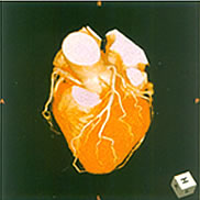 冠動脈の三次元画像 [10KB]