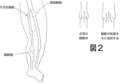 静脈の逆流が下肢のうっ血を引き起こす [14KB]