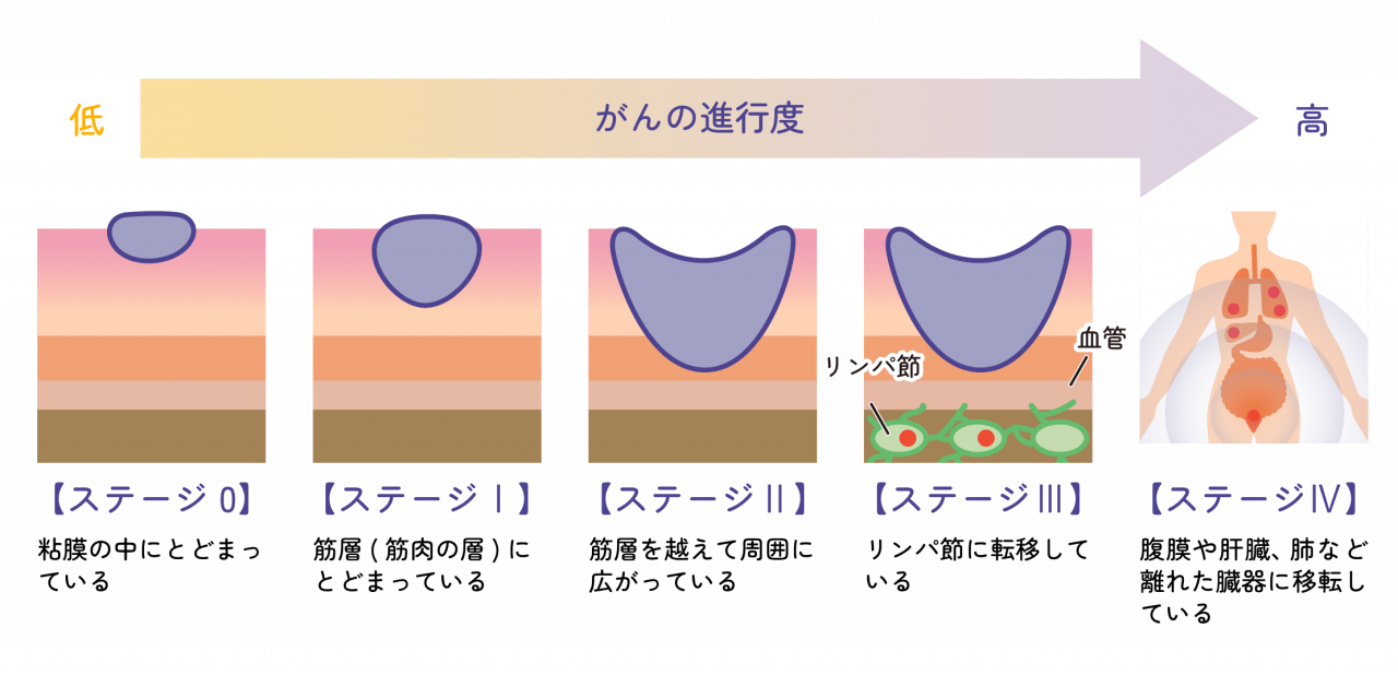 大腸 が ん 検便